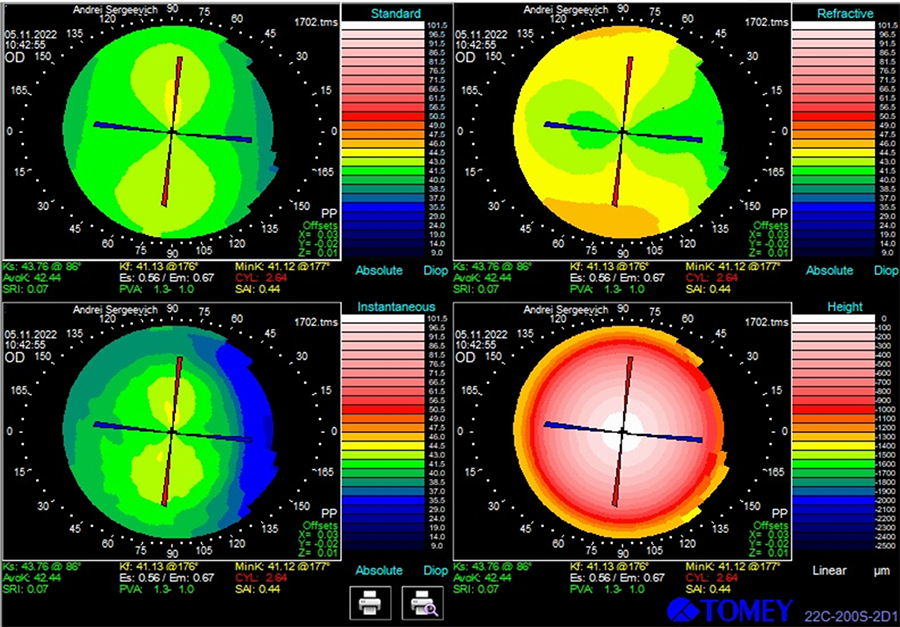kompyuternaya-keratotopografiya-2022-2.png